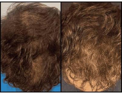 Hair Loss Solutions Dallas | Women’s Thinning Hair Specialist