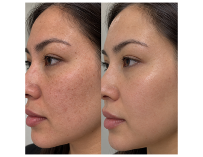 PRP Treatment in Toronto for Natural-Looking Skin Renewal
