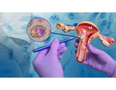 Modern Cervical Cancer Treatment in Noida by Dr. Manish Singhal