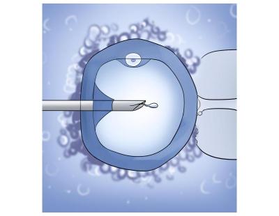 Expert ICSI Male Treatment in Delhi | Fertylity IVF