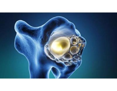Bone Cancer Specialist in Noida – Dr. Manish Singhal