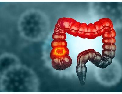 Find Colon Cancer Treatment in Noida with Dr. Manish Singhal