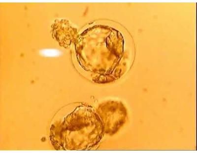 Blastocyst Transfer in Delhi with Personalized IVF Guidance | Fertylity IVF