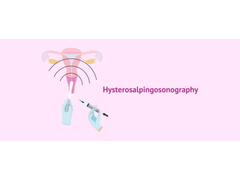 Hysterosalpingography in Delhi | Fertylity IVF Fertility Experts