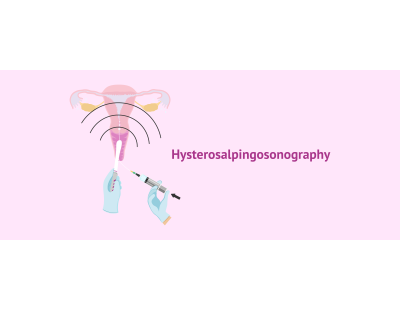 Hysterosalpingography in Delhi | Fertylity IVF Fertility Experts