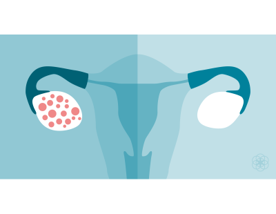 Best PCOD/PCOS Treatment in Delhi | Fertylity IVF Care