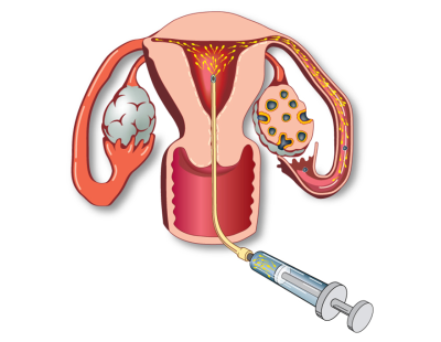 Affordable Intrauterine Insemination in Delhi | Fertylity IVF