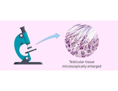 Sperm/Testicular/Tissue in Delhi | Fertylity IVF Experts