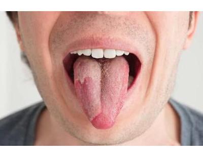 Are Oral Yeast Infections Contagious? Causes and Symptoms