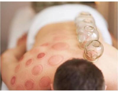 Cupping Therapy Services in Ambler, Pennsylvania