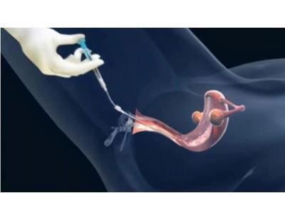 Trusted Intrauterine Insemination in Delhi | Fertylity IVF