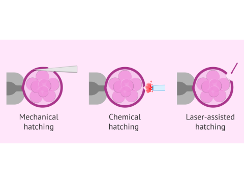 Assisted Embryo Hatching in Delhi for Your IVF Journey | Fertylity ivf