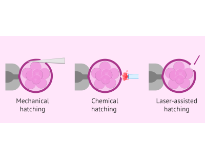 Assisted Embryo Hatching in Delhi for Your IVF Journey | Fertylity ivf