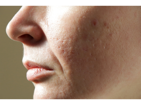 Discover Open Pores Treatment in Amritsar at Cosmetique by Dr Simrat Sandhu