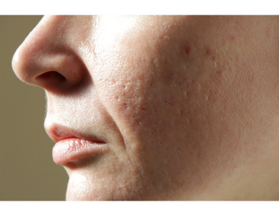 Discover Open Pores Treatment in Amritsar at Cosmetique by Dr Simrat Sandhu