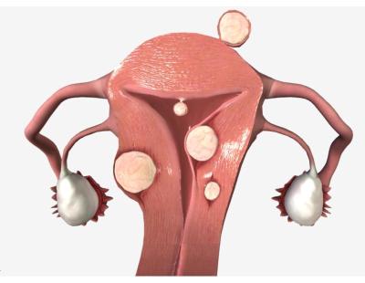 Fibroids in Delhi | Expert Uterine Fibroid Care at Fertylity IVF