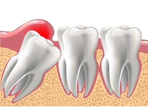 Looking For Wisdom Teeth Dentist Melbourne for Professional Dental Care?