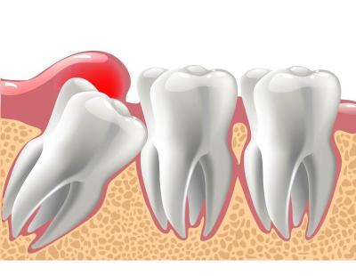 Wisdom Teeth Dentist Melbourne for Professional Dental Care by Dental Collingwood