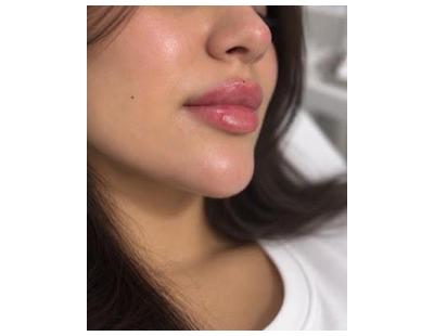 Lip Filler in Toronto for a Personalized Aesthetic Look