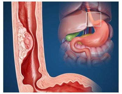 Expert Care for Esophageal Cancer in Noida | Dr. Manish Singhal