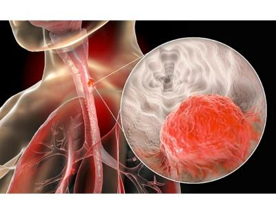 Modern Esophageal Cancer Treatment in Noida | Dr. Manish Singhal