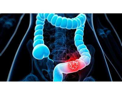 Patient-Focused Colon Cancer Treatment in Noida | Dr. Manish Singhal