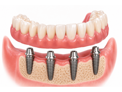 How Denture Implants Can Improve Everyday Comfort