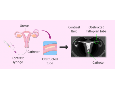 Hysterosalpingography in Delhi – Fertylity IVF Expert Care