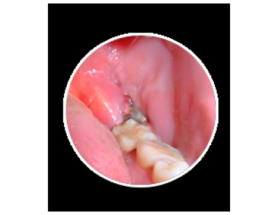 Looking for the Best Wisdom Teeth Removal Services for Comfortable Dental Care?