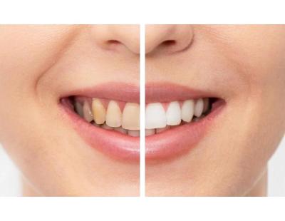 Book the Best Teeth Whitening Treatment in Thaltej Ahmedabad Today