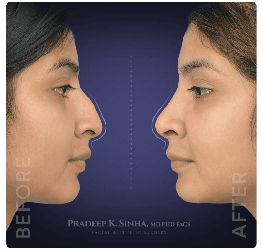 Atlanta’s Trusted Rhinoplasty Experts – Book a Consultation