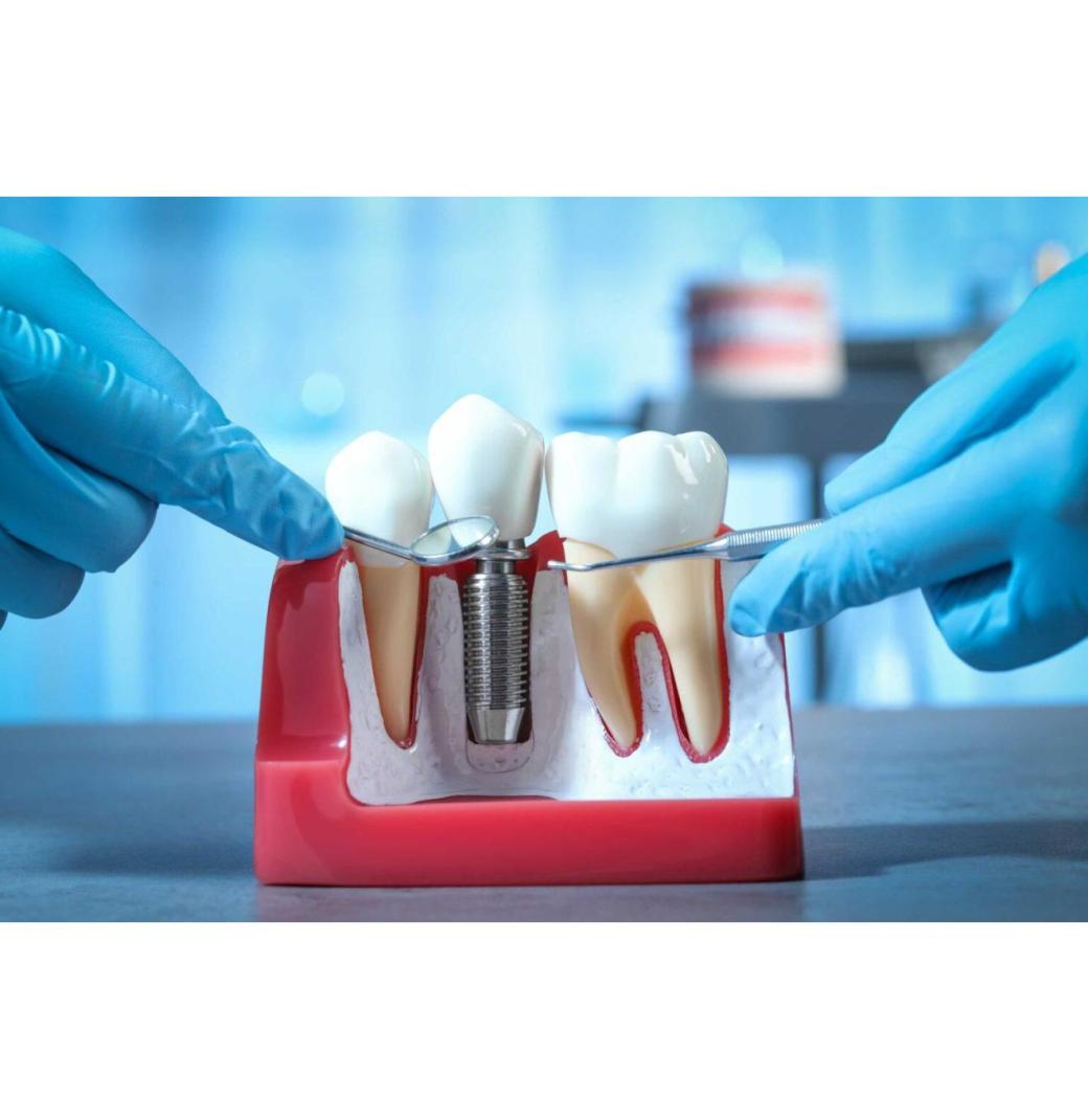 How Dental Implants Improve Oral Health in the Long Run?