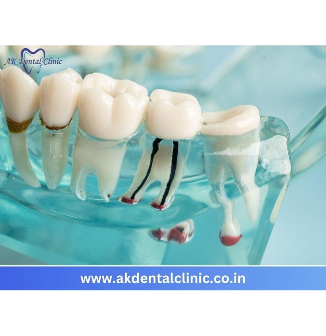 Advanced  Painless Root Canal Treatment in Mumbai | AK Dental Clinic