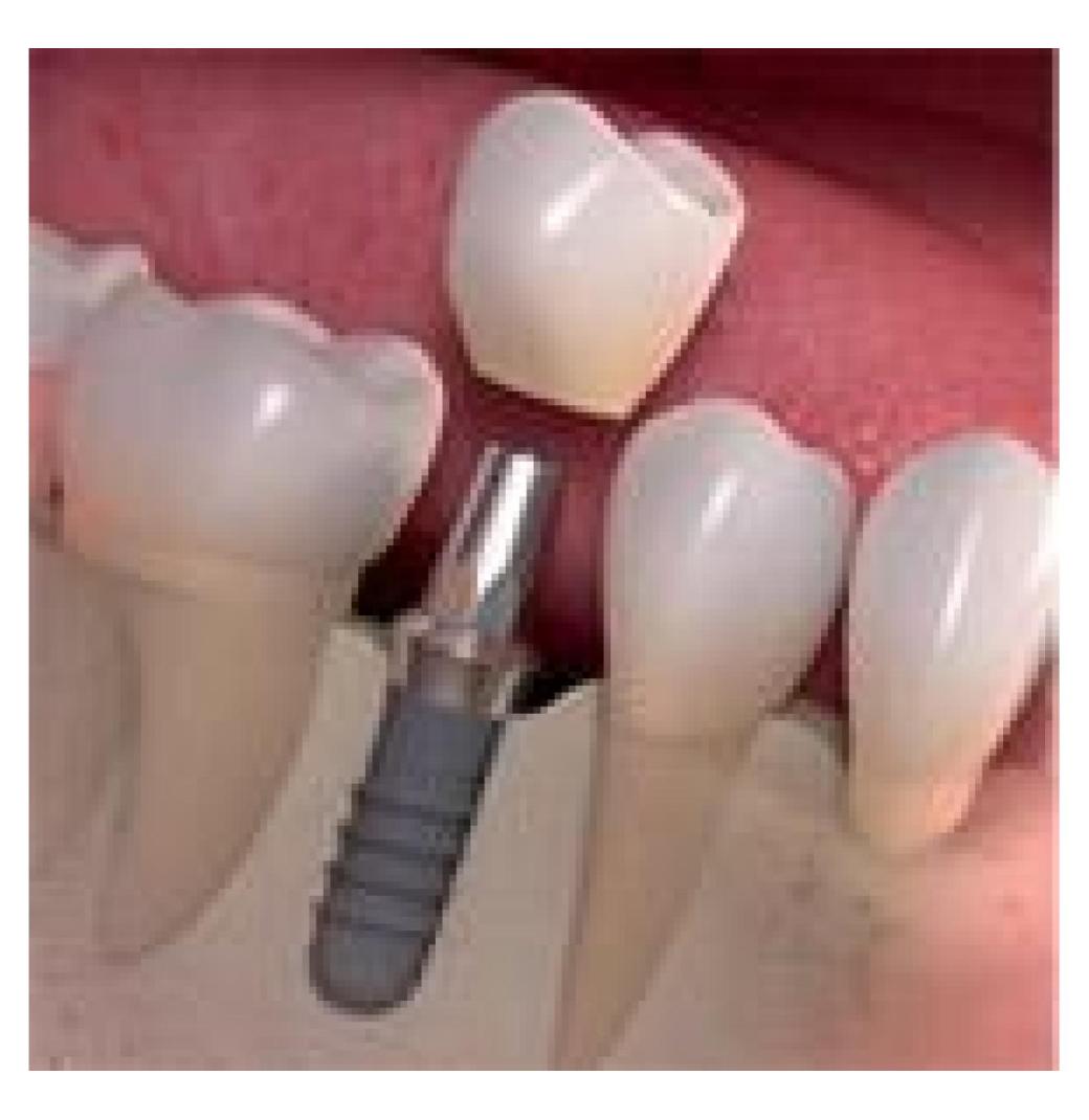 How can Dental Implant Treatment restore your confidence?