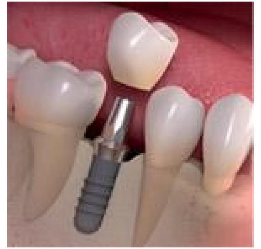 How can Dental Implant Treatment restore your confidence?