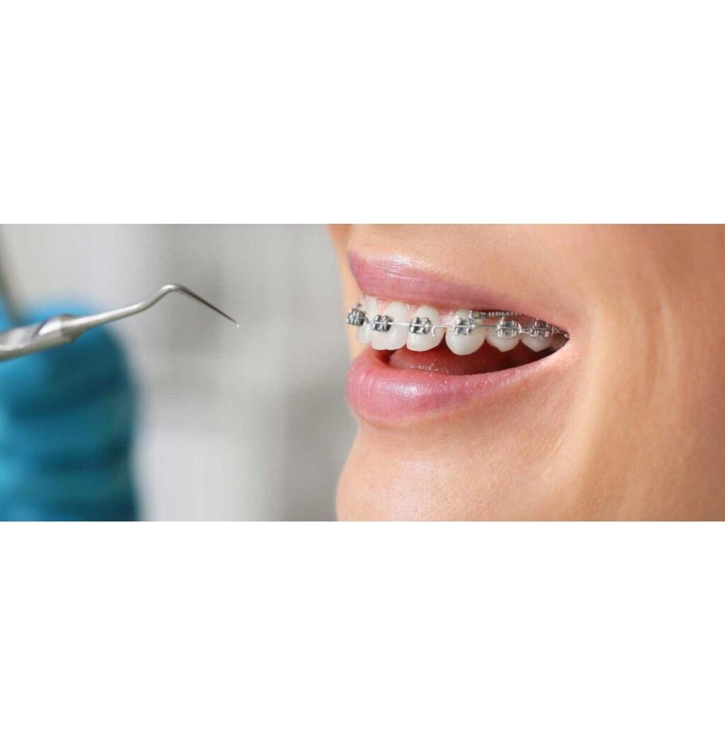 When Is Orthodontic Tooth Uncovering Recommended by Dentists? - 2/3