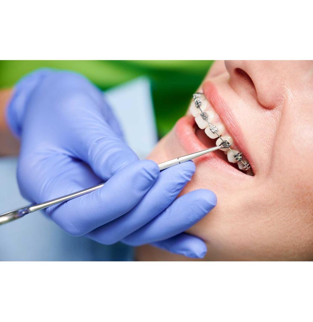 When Is Orthodontic Tooth Uncovering Recommended by Dentists? - 3/3