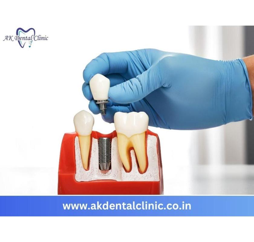 Trusted Dental Implant in Vile Parle, Mumbai | AK Dental Clinic