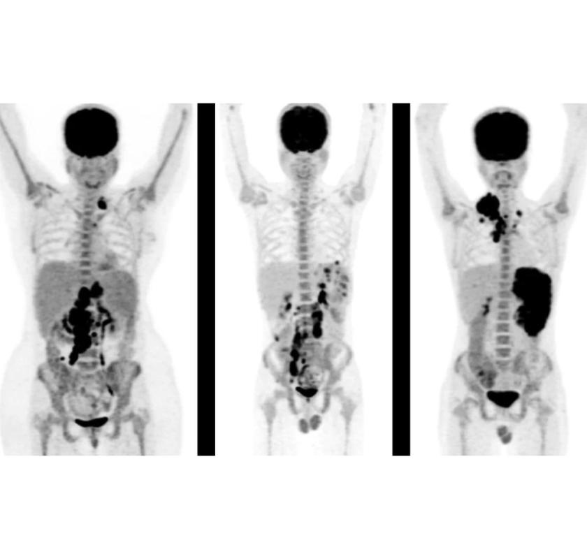 Advanced PET Scan in Mumbai for Accurate Cancer Diagnosis - Picture This Imaging 