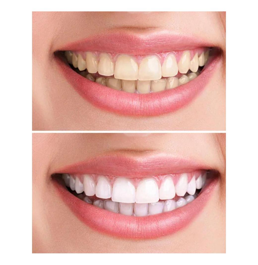 Professional Teeth Whitening – Lake Oswego Experts