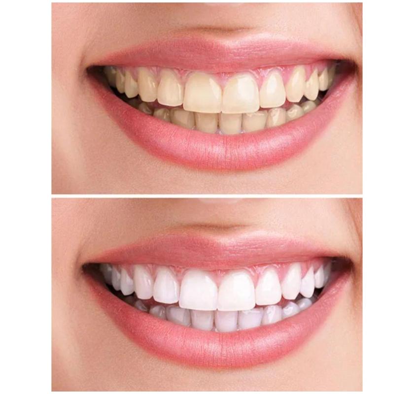 Professional Teeth Whitening – Lake Oswego Experts