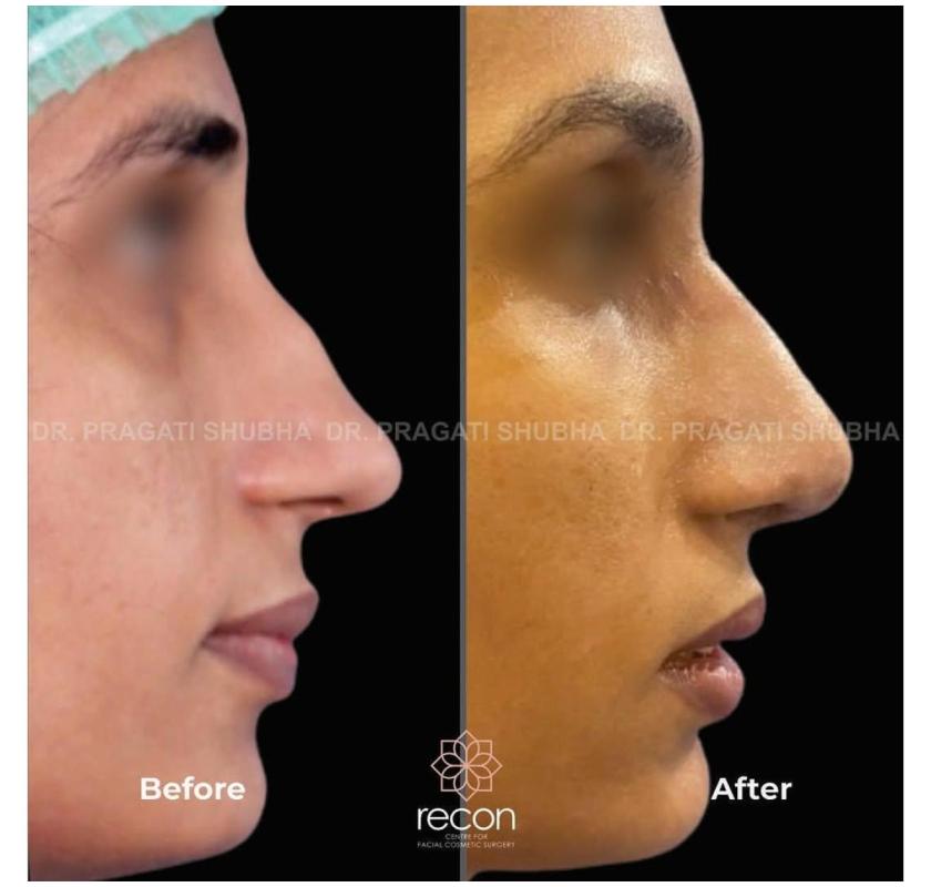 Rhinoplasty in Gurgaon | Best Plastic Surgeon – Recon Aesthetics