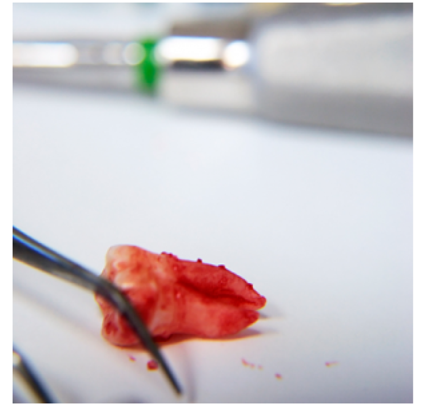 Affordable Wisdom Teeth Melbourne Services