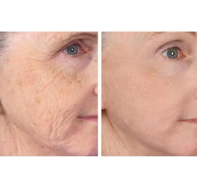 Fractionated CO2 Laser for Acne Scars & Pigmentation in Altamonte Springs.