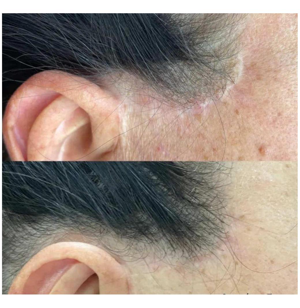 Expert Scar Camouflage Tattoo – Restore Confidence with Belle Clinic
