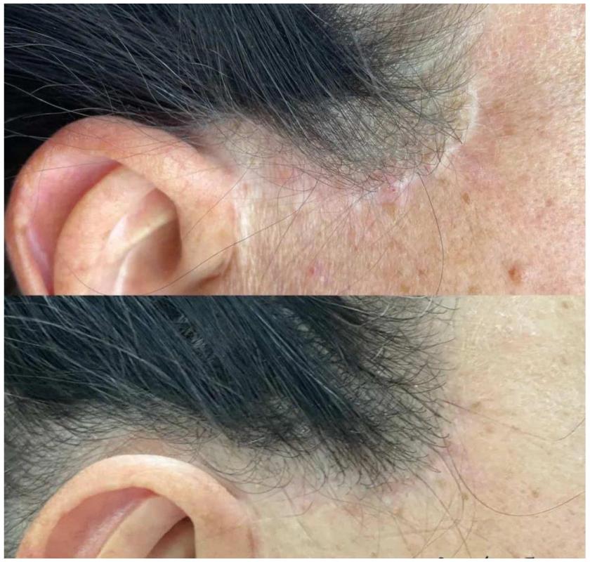 Expert Scar Camouflage Tattoo – Restore Confidence with Belle Clinic