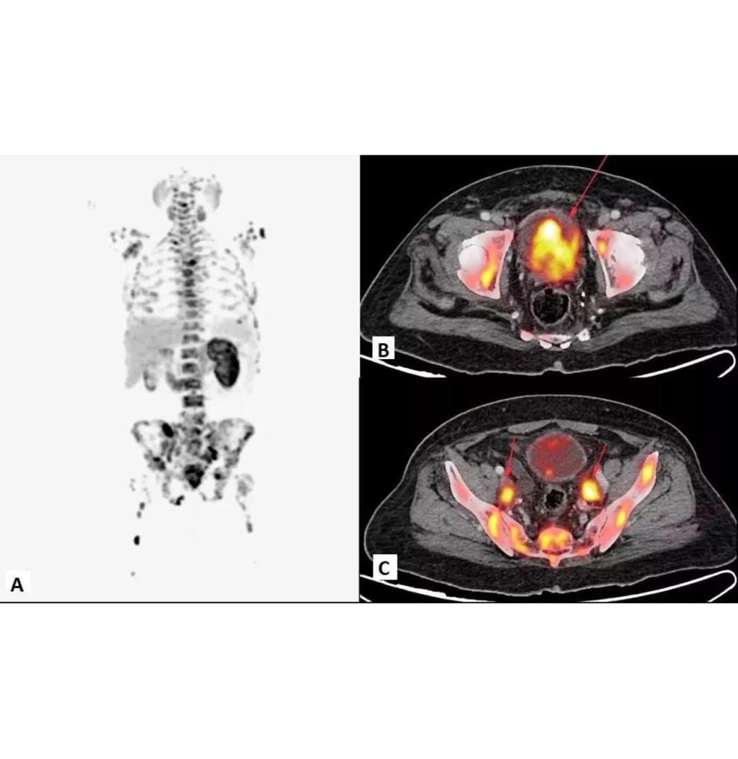 Precision FAPI PET CT Imaging for Early Detection - Picture This Imaging 