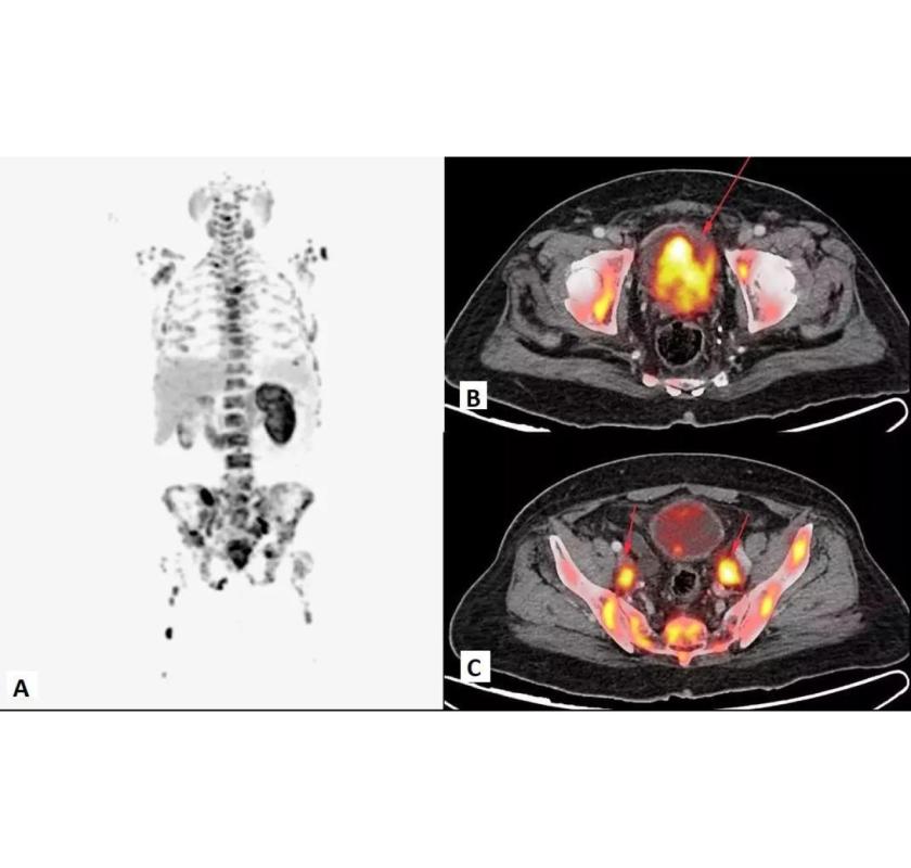 Precision FAPI PET CT Imaging for Early Detection - Picture This Imaging 