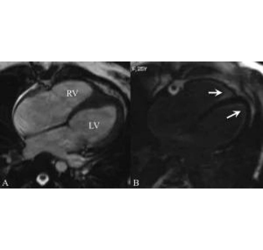 Precise Heart MRI Services for Accurate Cardiac Care - Picture This Imaging 