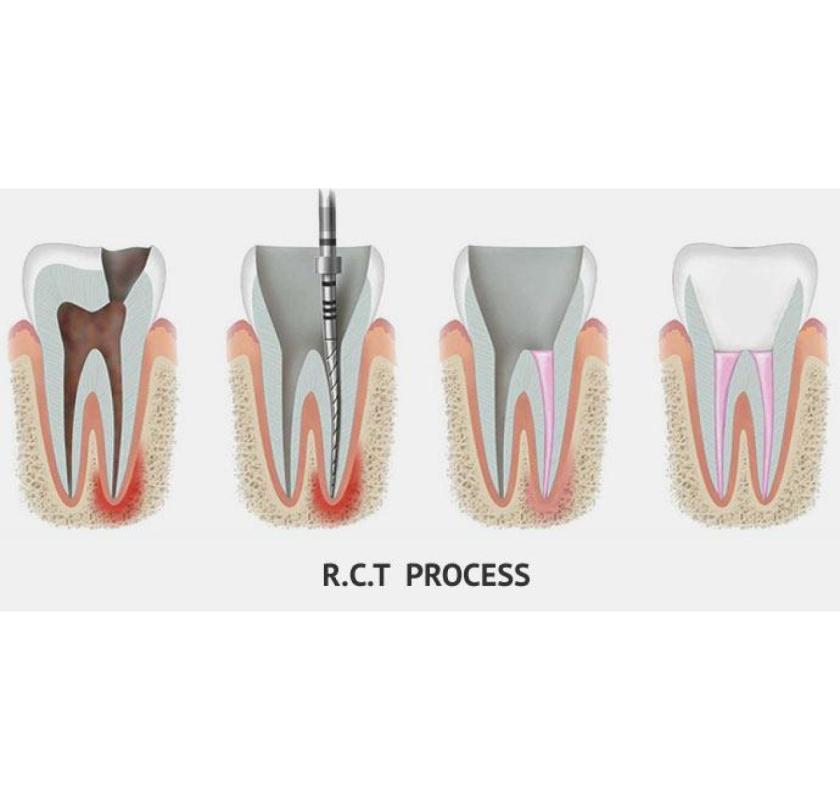 Save Your Tooth – Advanced Root Canal Treatment in Noida